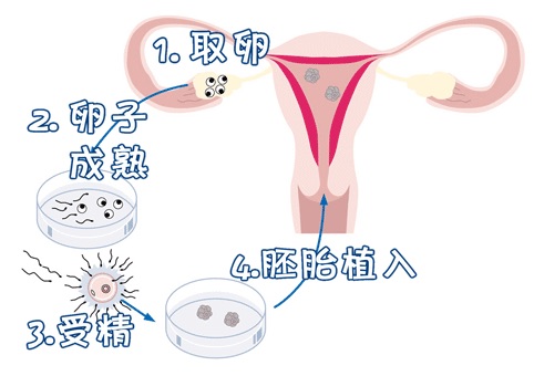 无精症案例